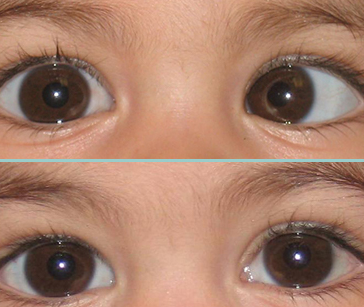 علاج انحراف العين - الحول
